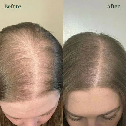 Kesaarose Rosemary Shampoo For Hair Growth (Buy 1 Get 1 Free 🔥🔥)